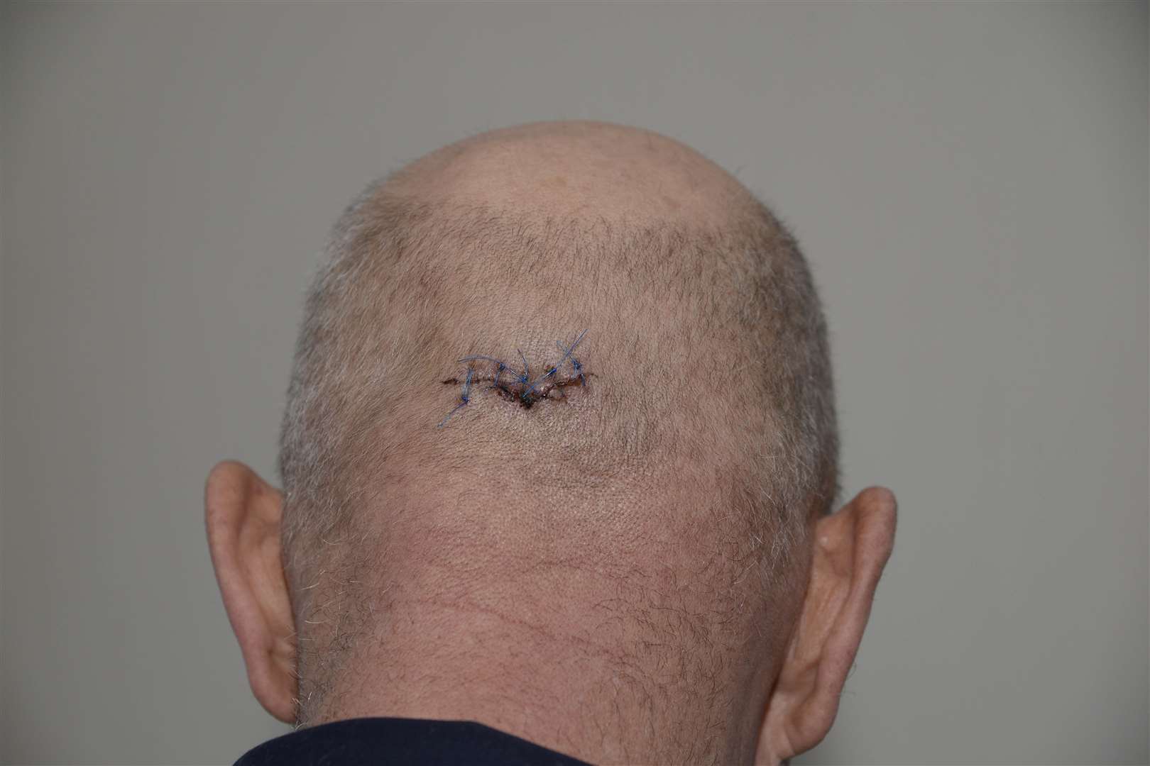 The cut left on Jim Tedder's head. Picture: Paul Amos