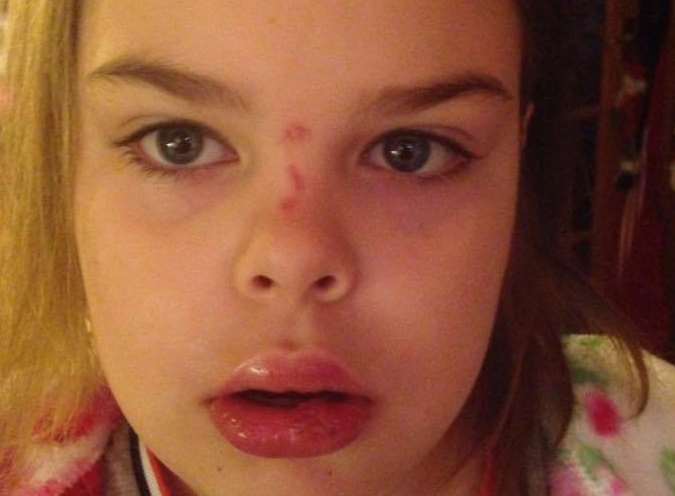 Olivia came away from her fall with a split lip and a grazed nose
