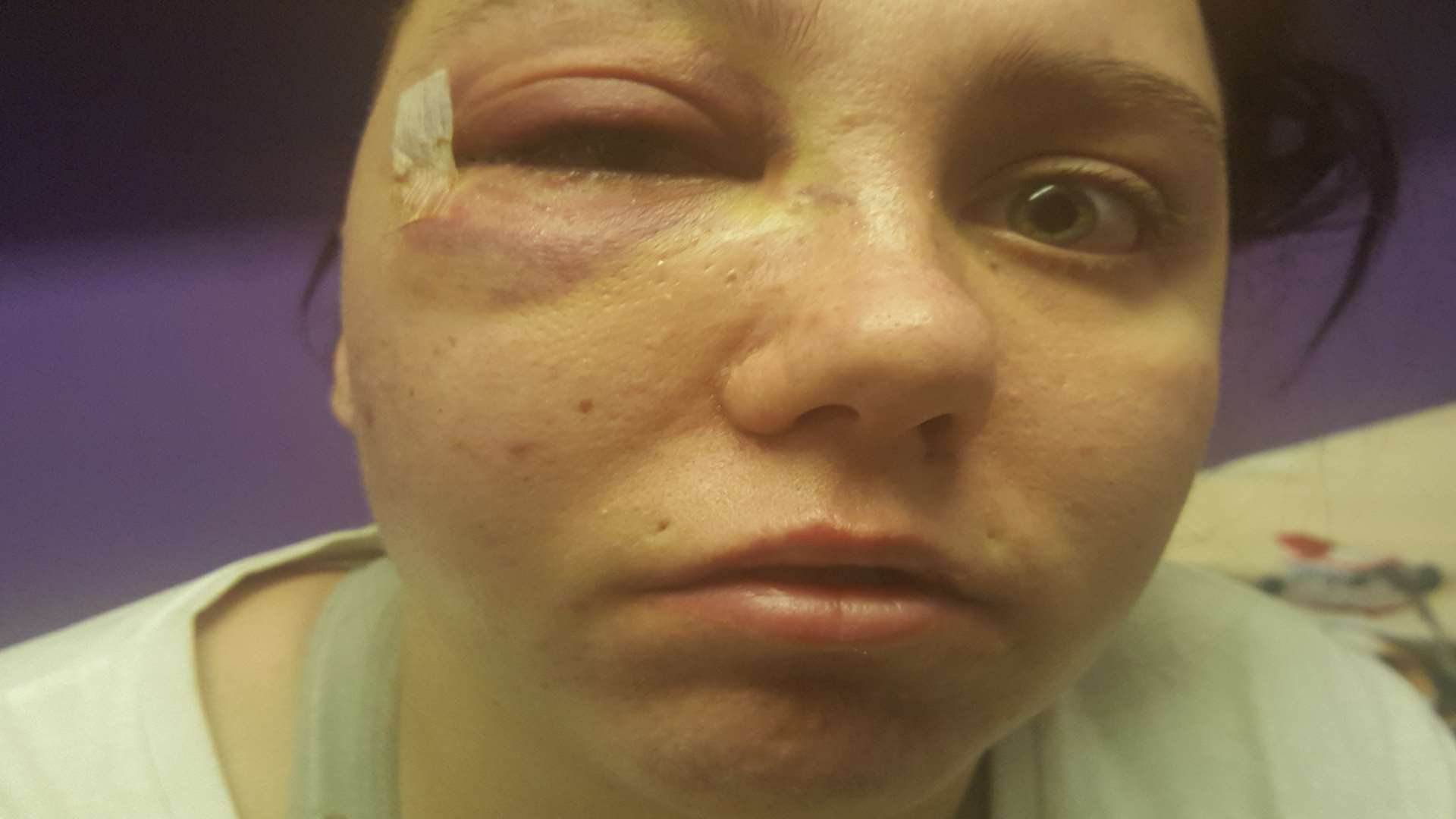 Cora's eye was left badly swollen and bruised