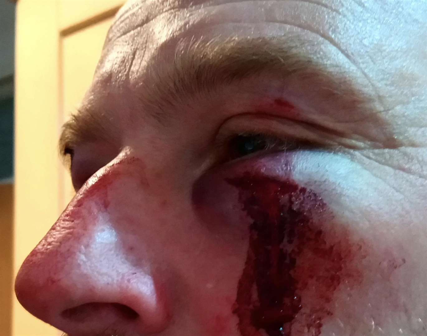 A saboteur sustained injuries that the group claims were caused by hunt supporters.