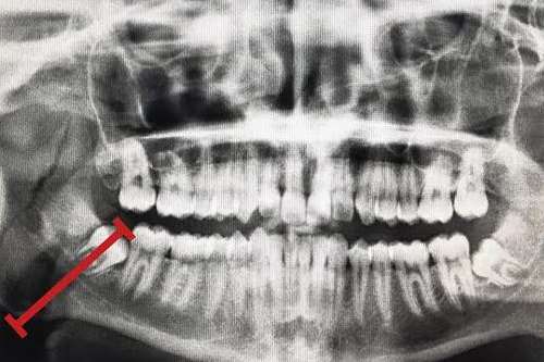 An X-ray showing Aaron Woodward's broken jaw. The fracture can be seen the the left of his mouth