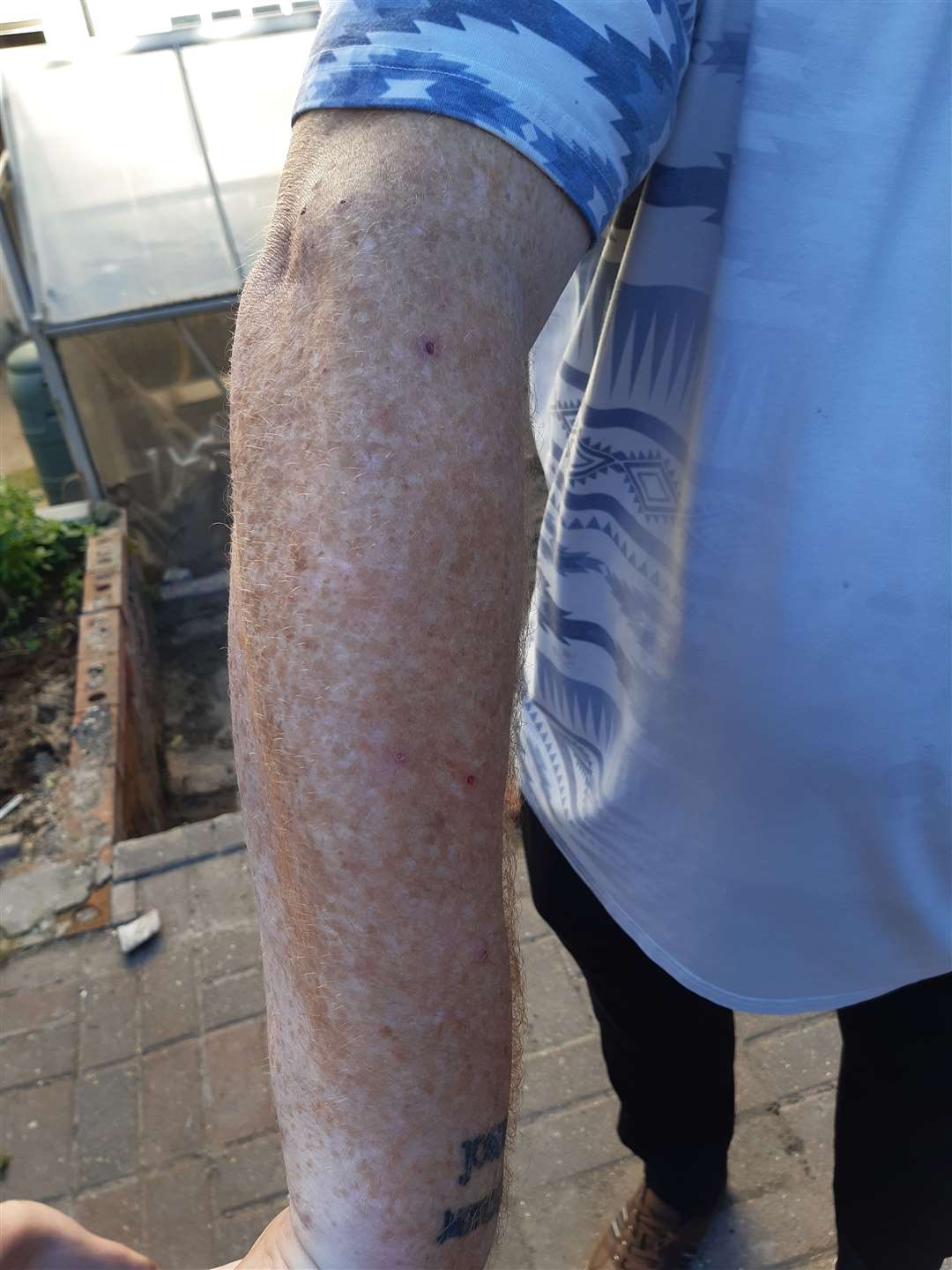 Bug bites on Stephen's arm