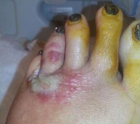Alison Blackburn's foot after she was bitten by a false widow spider