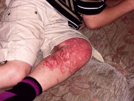 Jonathan Asplin's leg - still covered in sting marks