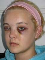 Kelsey Holsten- battered