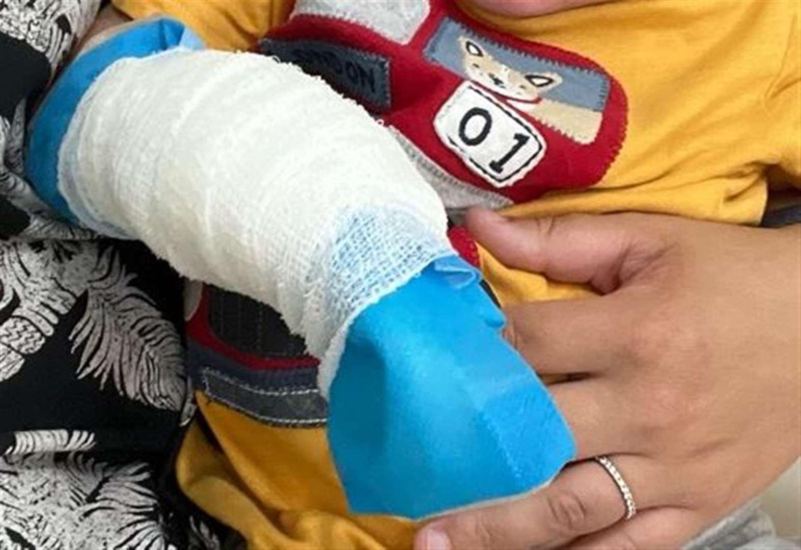 Toddler suffers second-degree burn as skate park ramp overheats