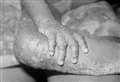 Further monkeypox cases reported in Kent