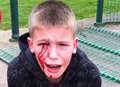Boy injured as metal fence hits his face in play area