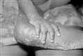New advice for those with mystery rashes as monkeypox cases almost double