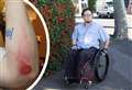 Wheelchair user fell from ramp after cars blocked bus stop