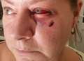 Gran’s eye socket fractured in brutal attack 