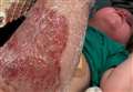 Youngster suffers horror burns in cafe accident