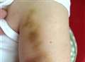 Police probe woman’s bruises at care unit