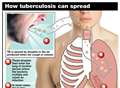 Care worker's TB triggers patient screen tests