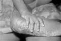 What to do if you have monkeypox symptoms