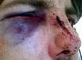 Man suffers facial injuries after assault