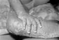 Kent's first suspected monkeypox cases reported
