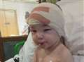 Toddler's six-hour surgery to remould skull