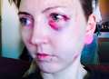 Barmaid beaten up in horrific 'hate crime' attack