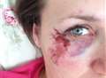 Mum injured as police warn of spate of rock attacks