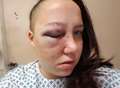 VIDEO: Woman blinded in beer can attack urges culprit to come forward