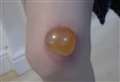 Boy's giant blister after 'brush with hogweed'