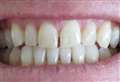 Woman fined for illegal teeth whitening