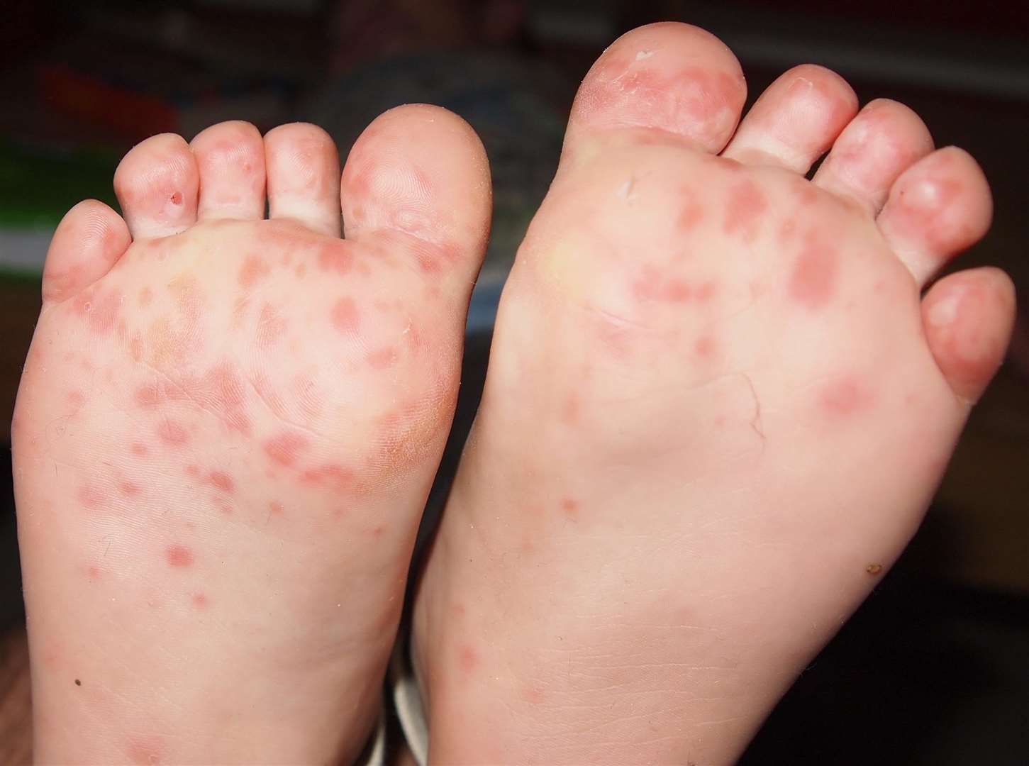 Hand, foot and mouth can cause a rash on the child's feet. Library image.