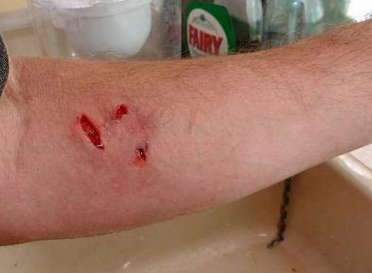 Bite marks on Robert Barnes' arm after the attack in Warden Road, Eastchurch