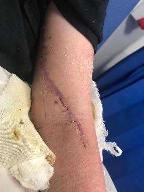 "I tell the girls I had to fight off a shark", says Harrison Martin about his operation scar