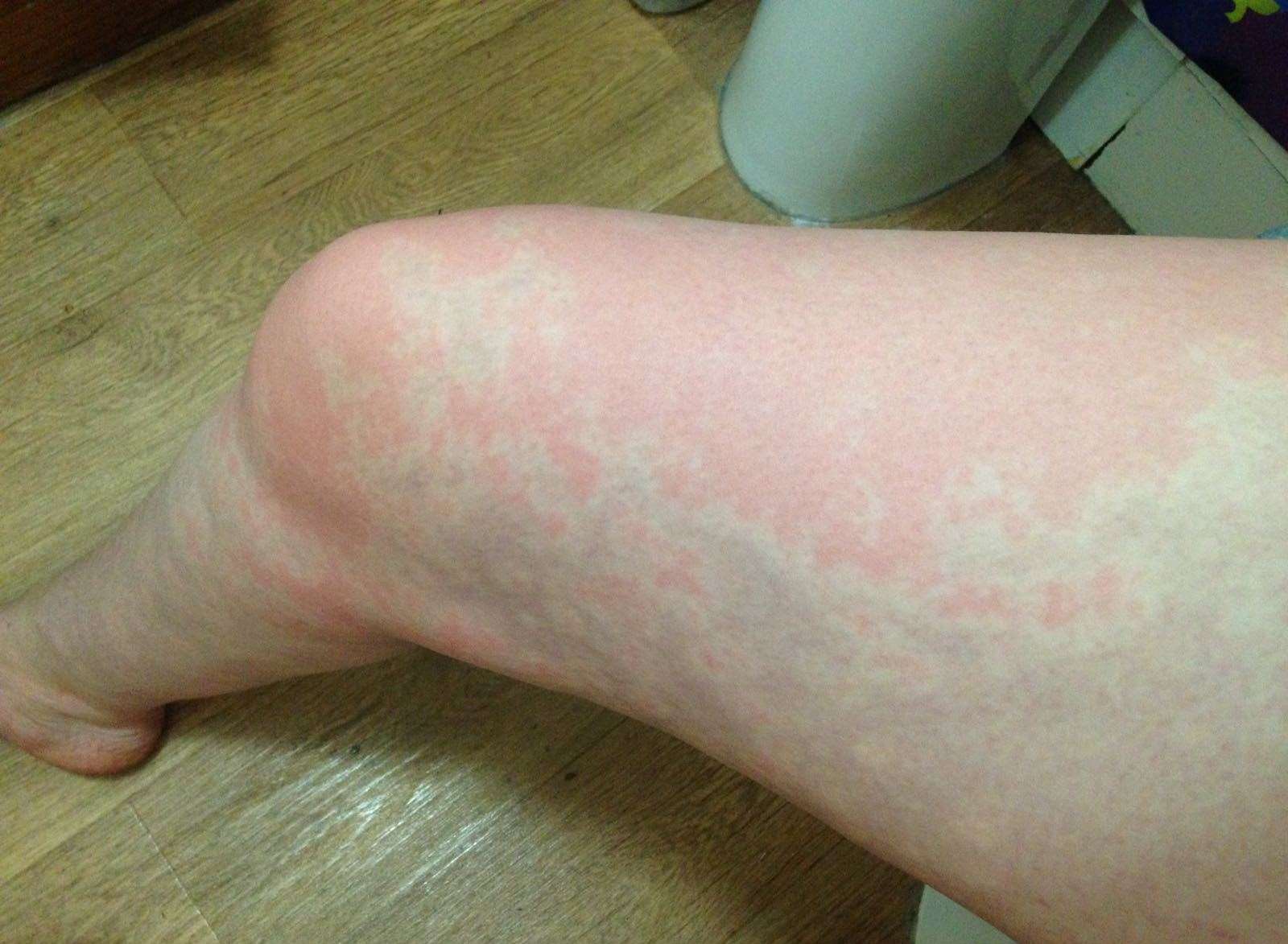 One of the symptoms is a burning rash on Megan's leg