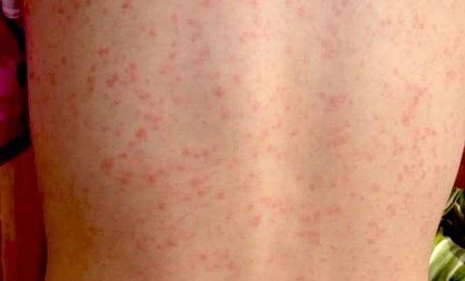 The number of Scarlet Fever cases has rocketed compared to previous years