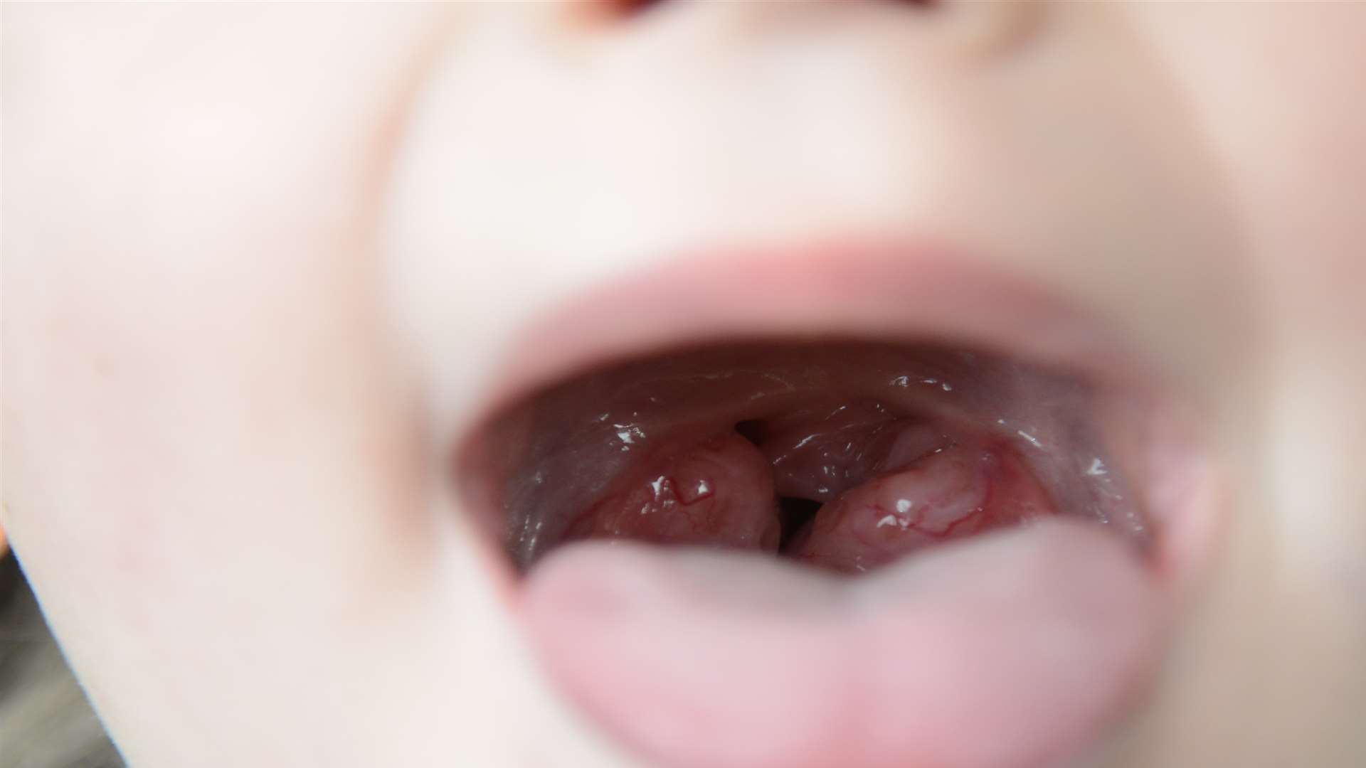 Ellie-Mae's tonsils are so swollen she struggles to eat and sleep