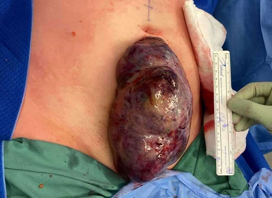 The huge tumour removed from Hannah