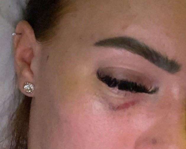 Leonie Waldock's bruised eye. Picture: Leonie Waldock