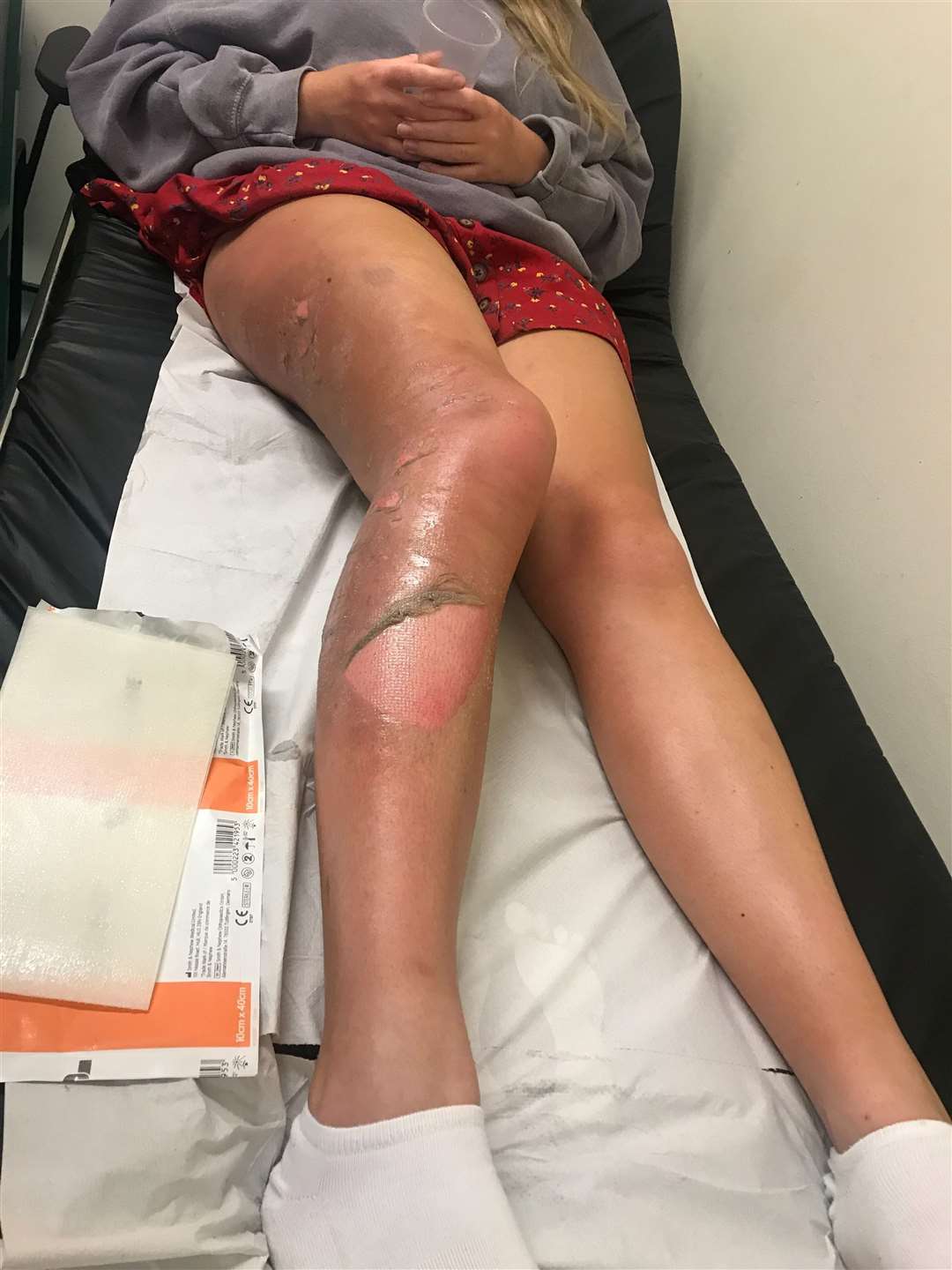 Leone suffered severe burns on her legs. Image: Leone Cook