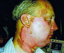 Firefighter Mat Barney's injuries following a fire on Dartford Heath in 2005