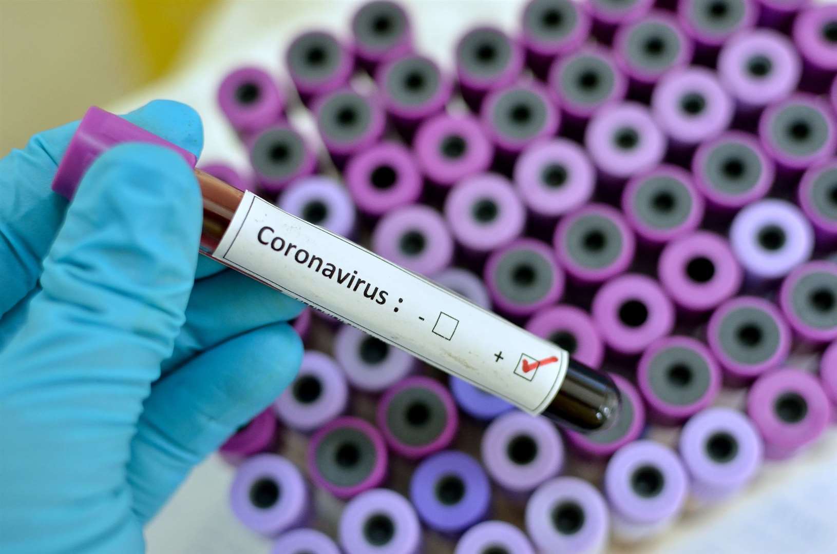 Blood sample with respiratory coronavirus.