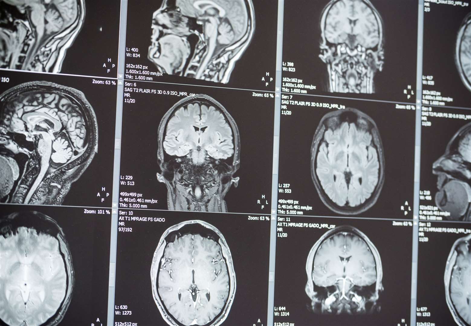 MRI scans can take detailed images of organs such as the brain. Picture: iStock