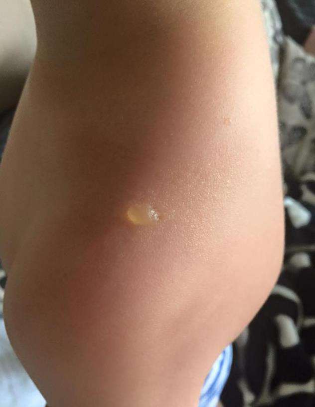 The blister on four-year-old Jayden Freeman's shoulder