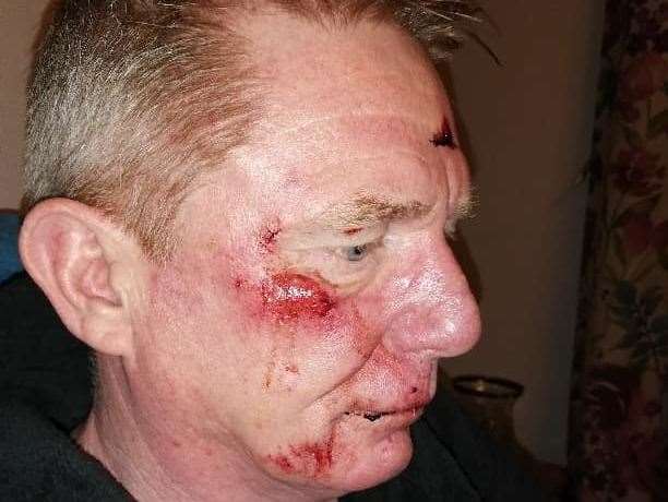Martin Nicholls suffered nasty facial injuries (8083026)