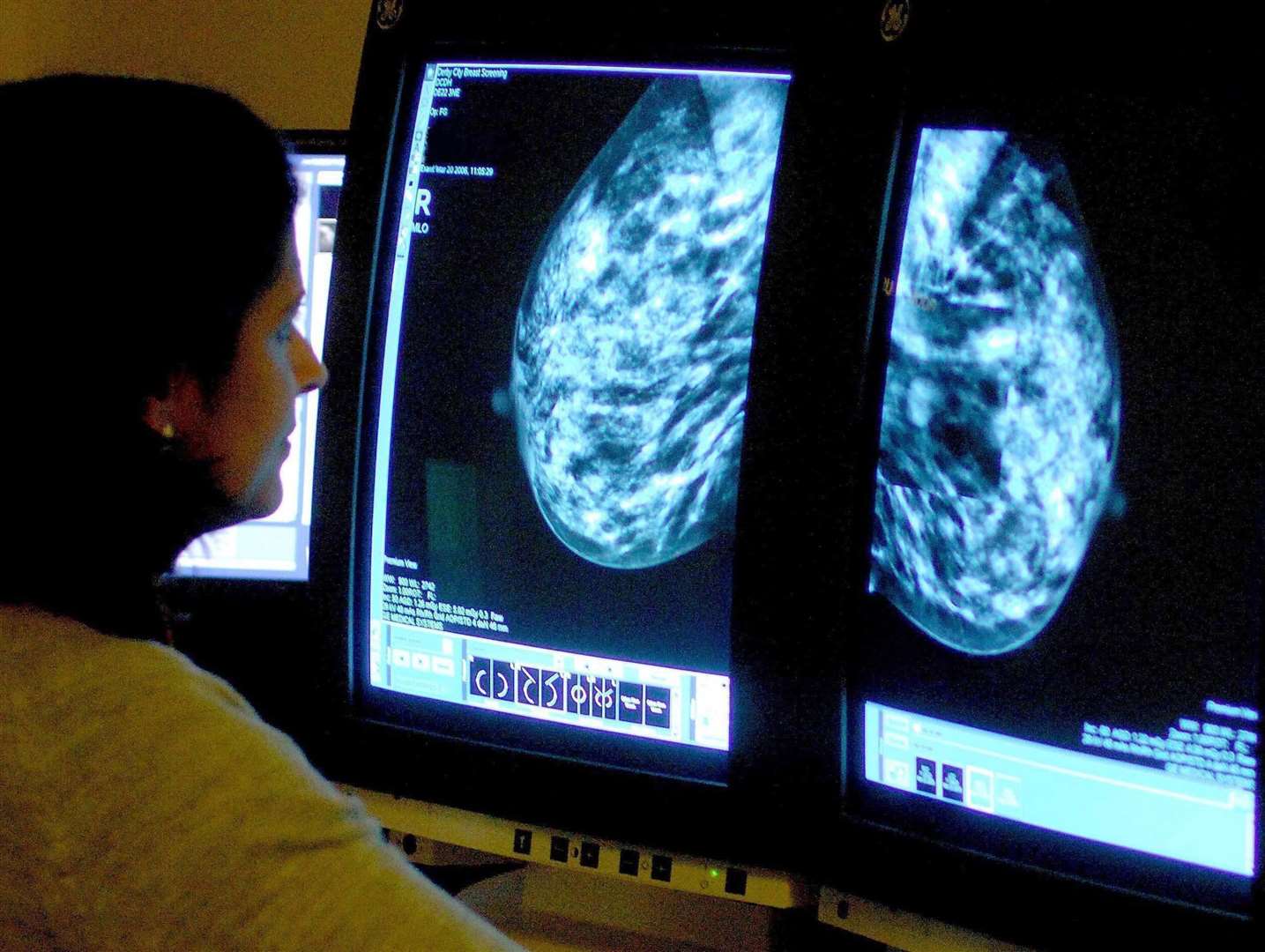 Breast Cancer Now says breast cancer screening services have been hugely affected by the pandemic