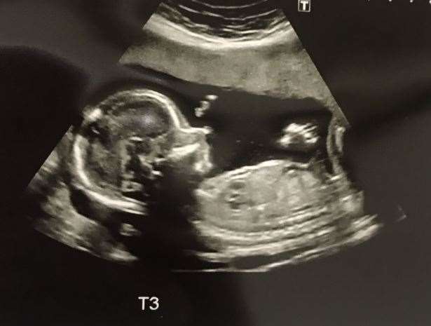 Scans showing triplet three