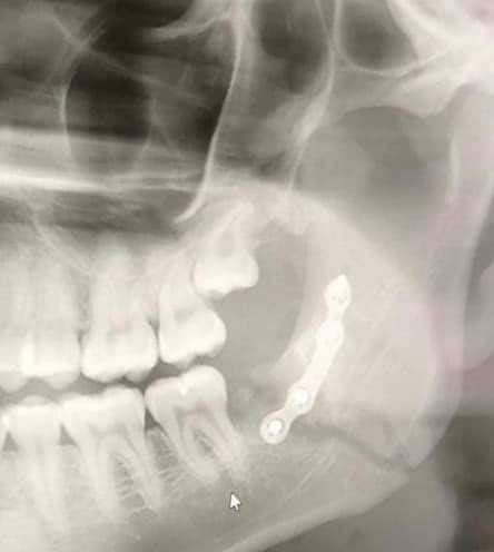 Sam Mason needed a metal plate in his jaw after an unprovoked attack. (10720933)