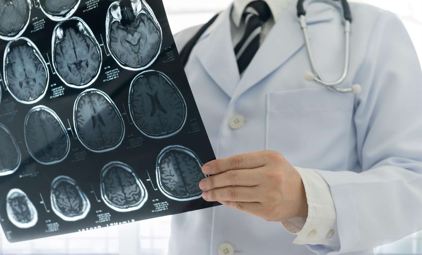 The changes to stroke care is out for consultation. Picture: Getty Image