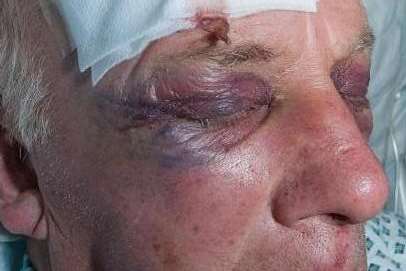 Robert Reynolds, 60, suffered several fractures to his skull after being assaulted in his own home