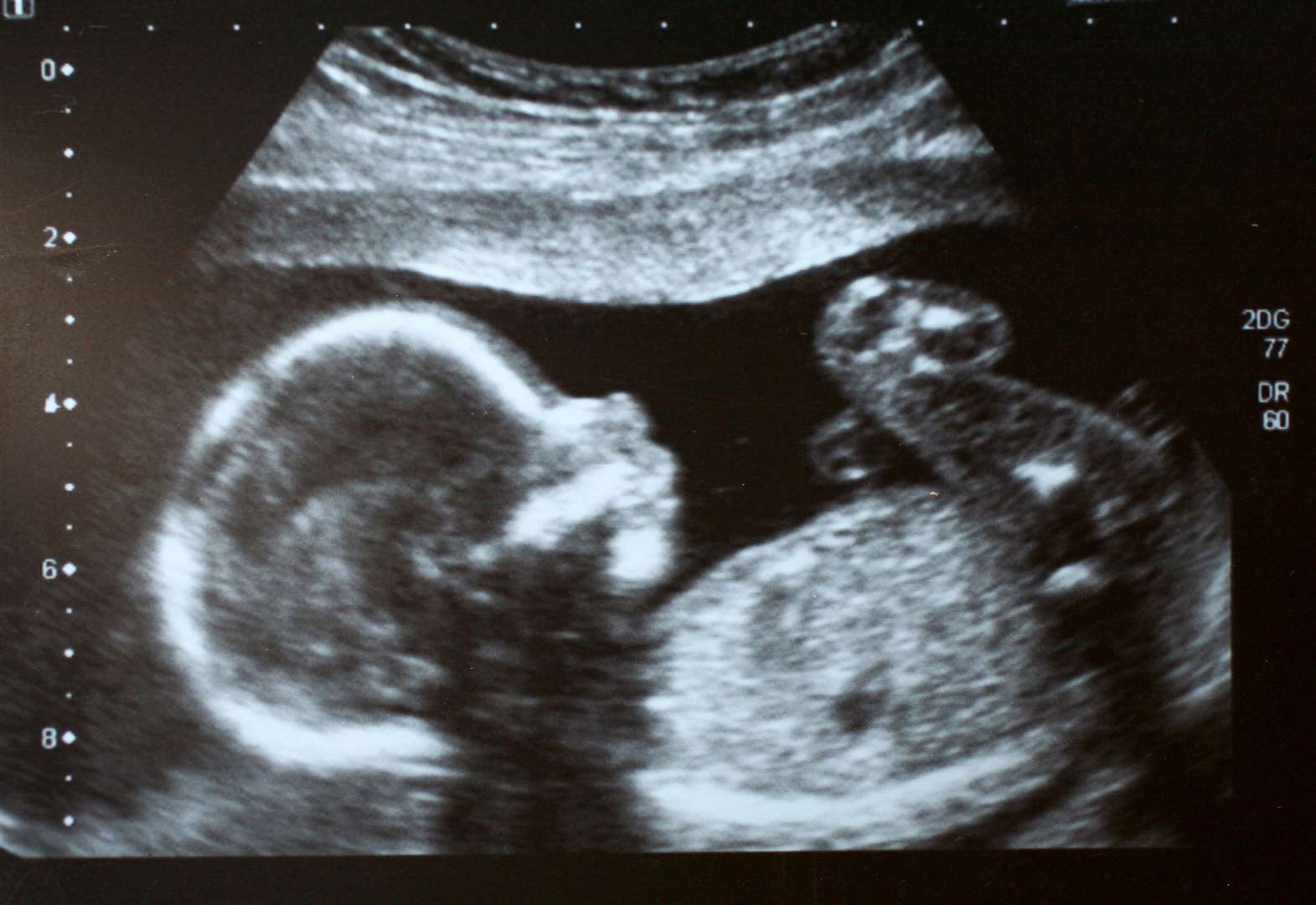 The foetus can be protected via immunity passed through the placenta. Image: Stock photo.