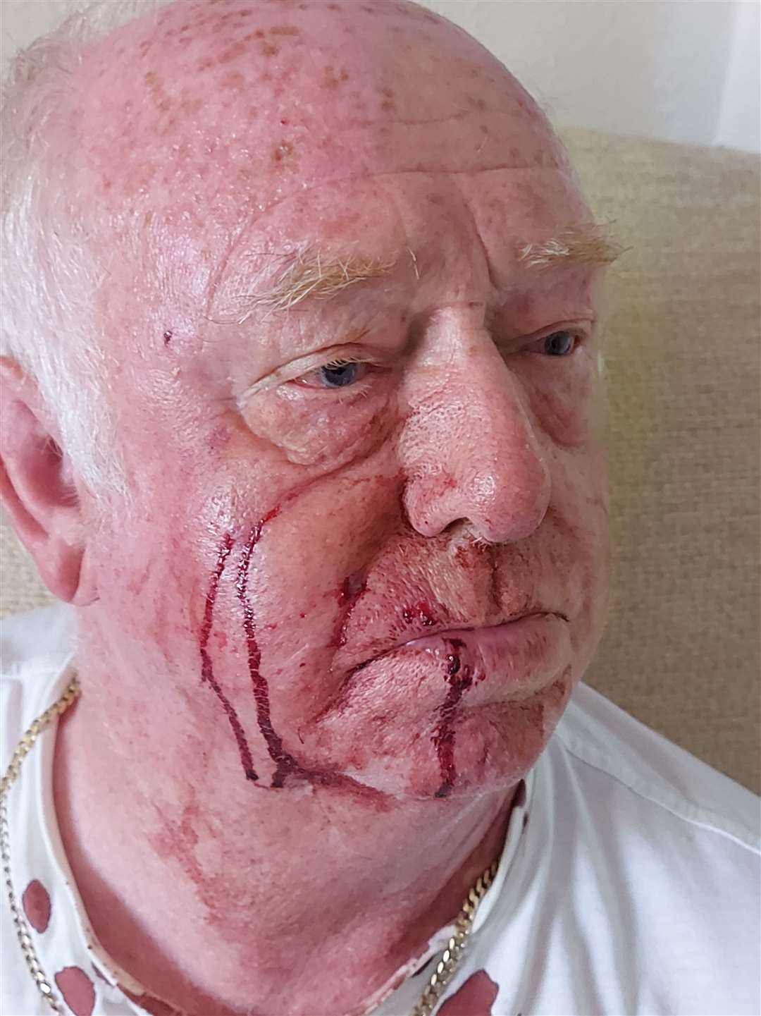 Mr Champs suffered facial injuries in the alleged attack