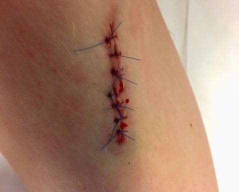 Oliver Odlum needed eight stitches after cutting his leg