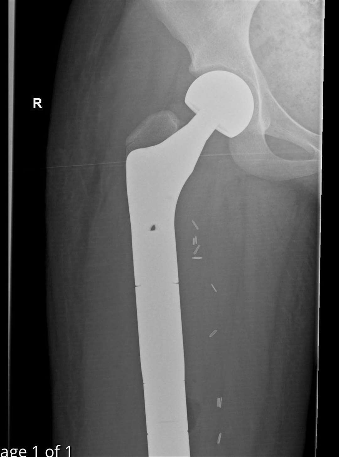 An x-ray of the implant that replaced Ivie Adam's right femur bone